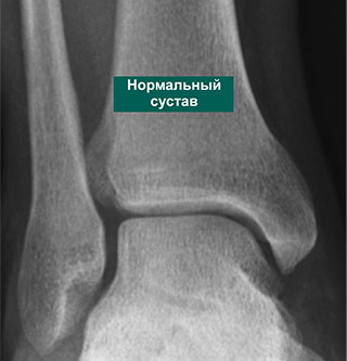 Реферат: Переломы лодыжек, повреждения голеностопного сустава